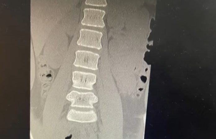 Hasil pemindaian MRI Iqa yang dibagikan ibunya setelah ia menjadi korban prank di sekolah. (Foto: TikTok azera5276/The Straits Times)