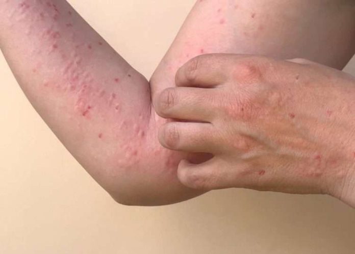 Gambaran ruam pada penderita Mpox (FOTO : RRI/Kementerian Kesehatan/THE EDITOR)